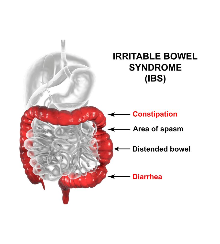 Image depicting the symptoms of irritable bowel syndrome
